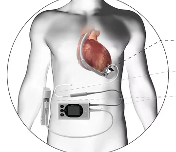 Left Ventricular Assist Device (LVAD) project image from Peter Sun’s original portfolio.